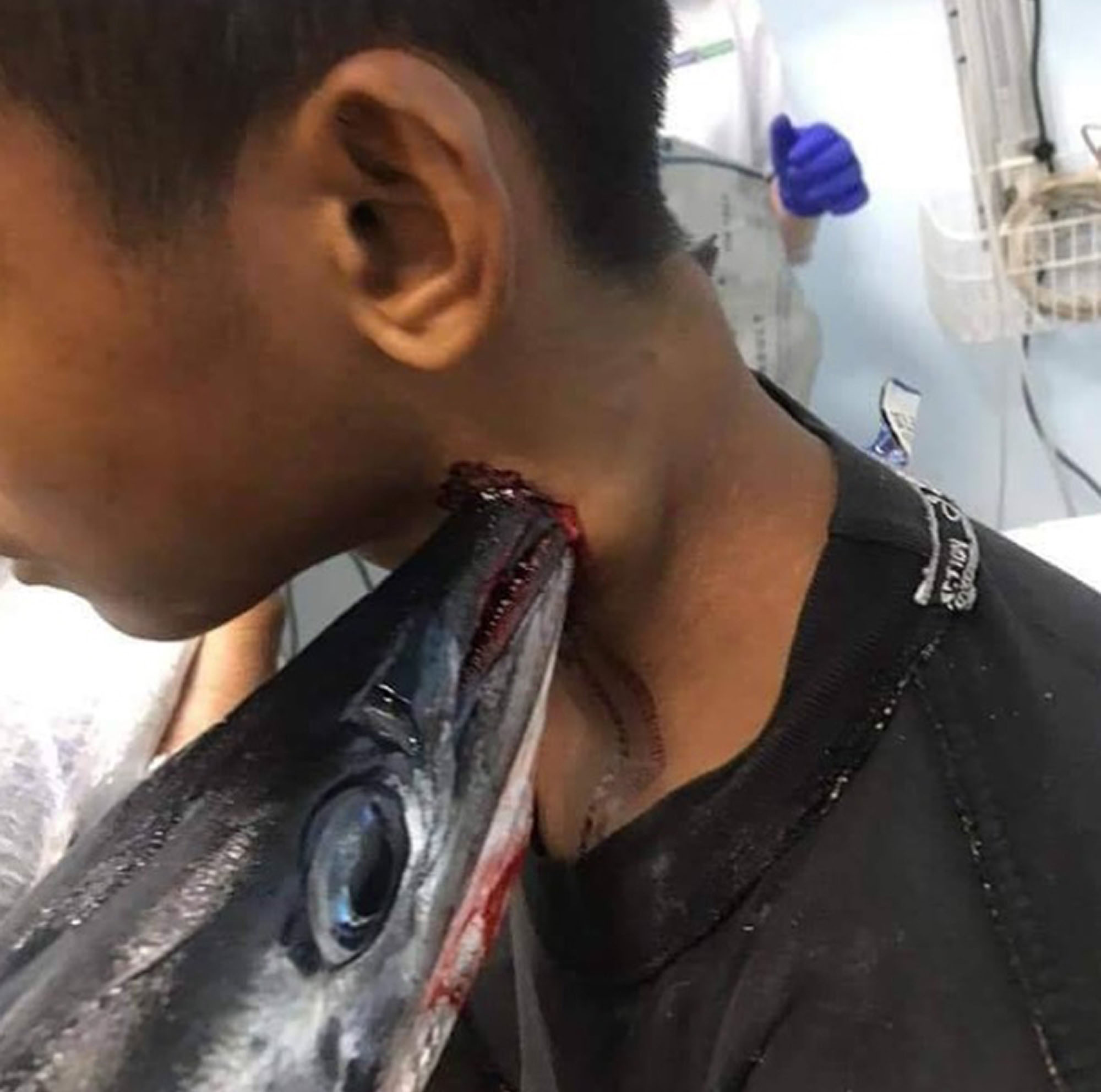 Read more about the article Teen Survives Being Impaled In Neck By Fish