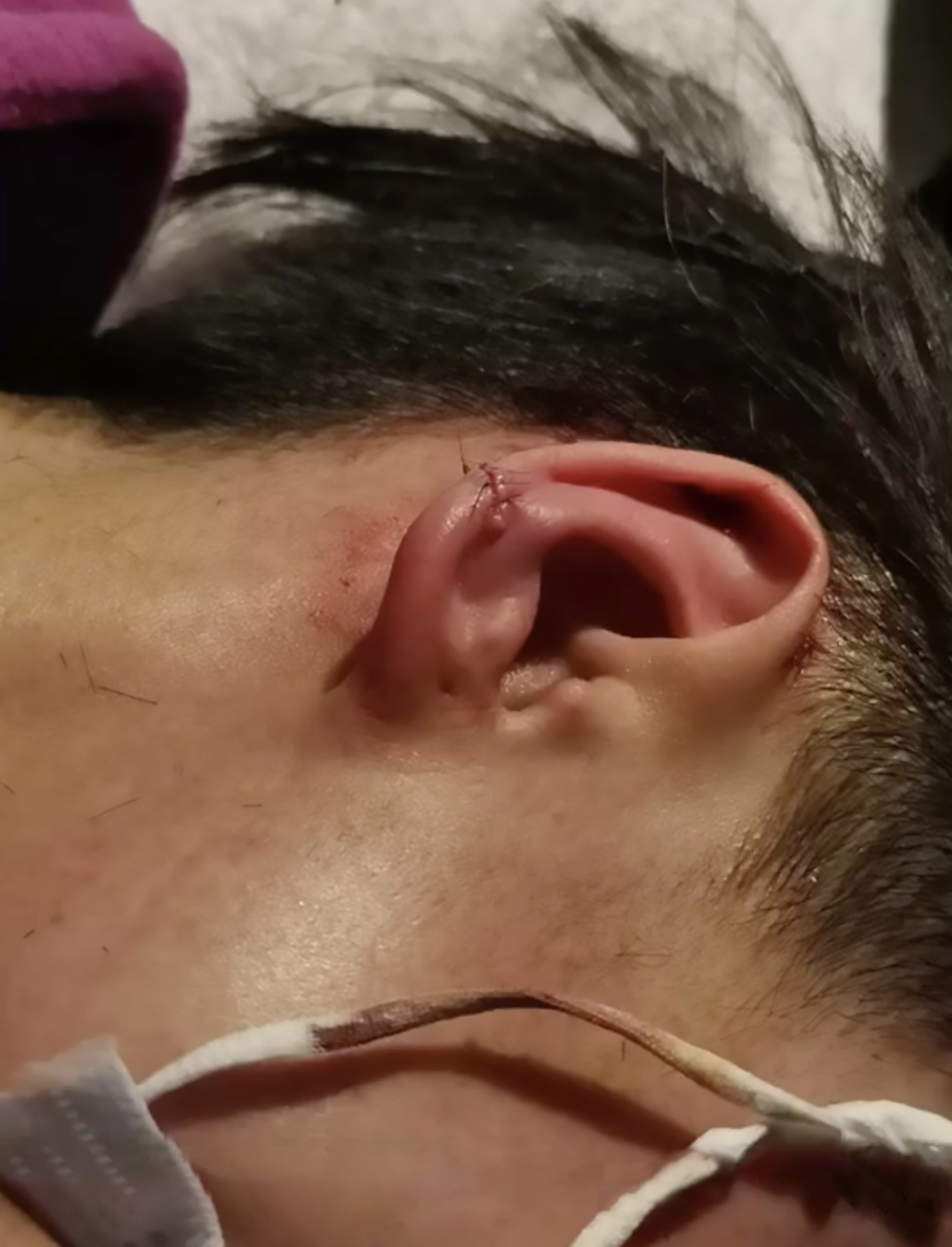Read more about the article Medic Stitches Colleagues Ear Using Strand Of Her Hair