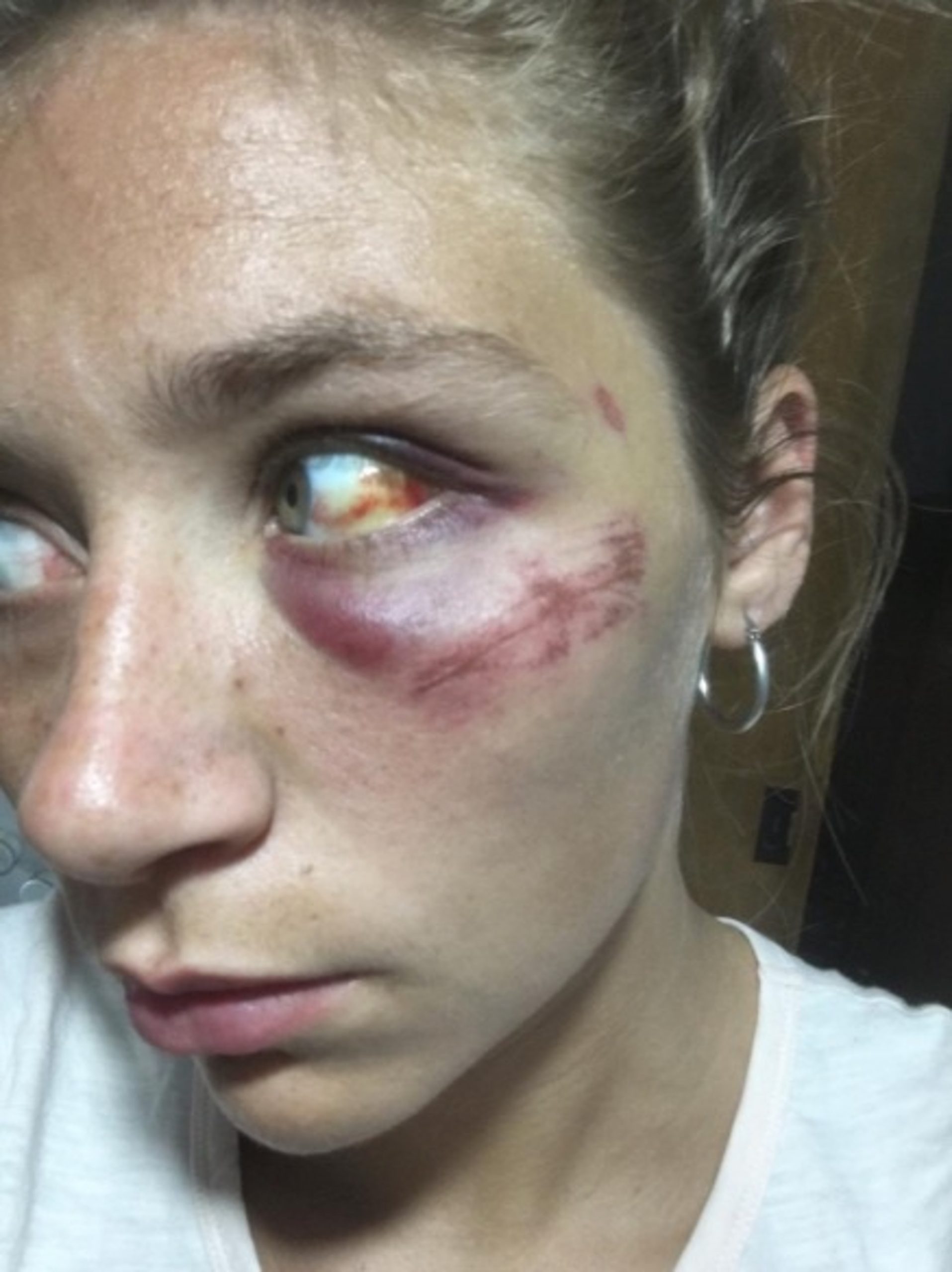Read more about the article Woman Shares Images Of Horrific Injuries After BF Abuse