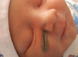 Read more about the article Docs Cut Newborns Face During C-Section