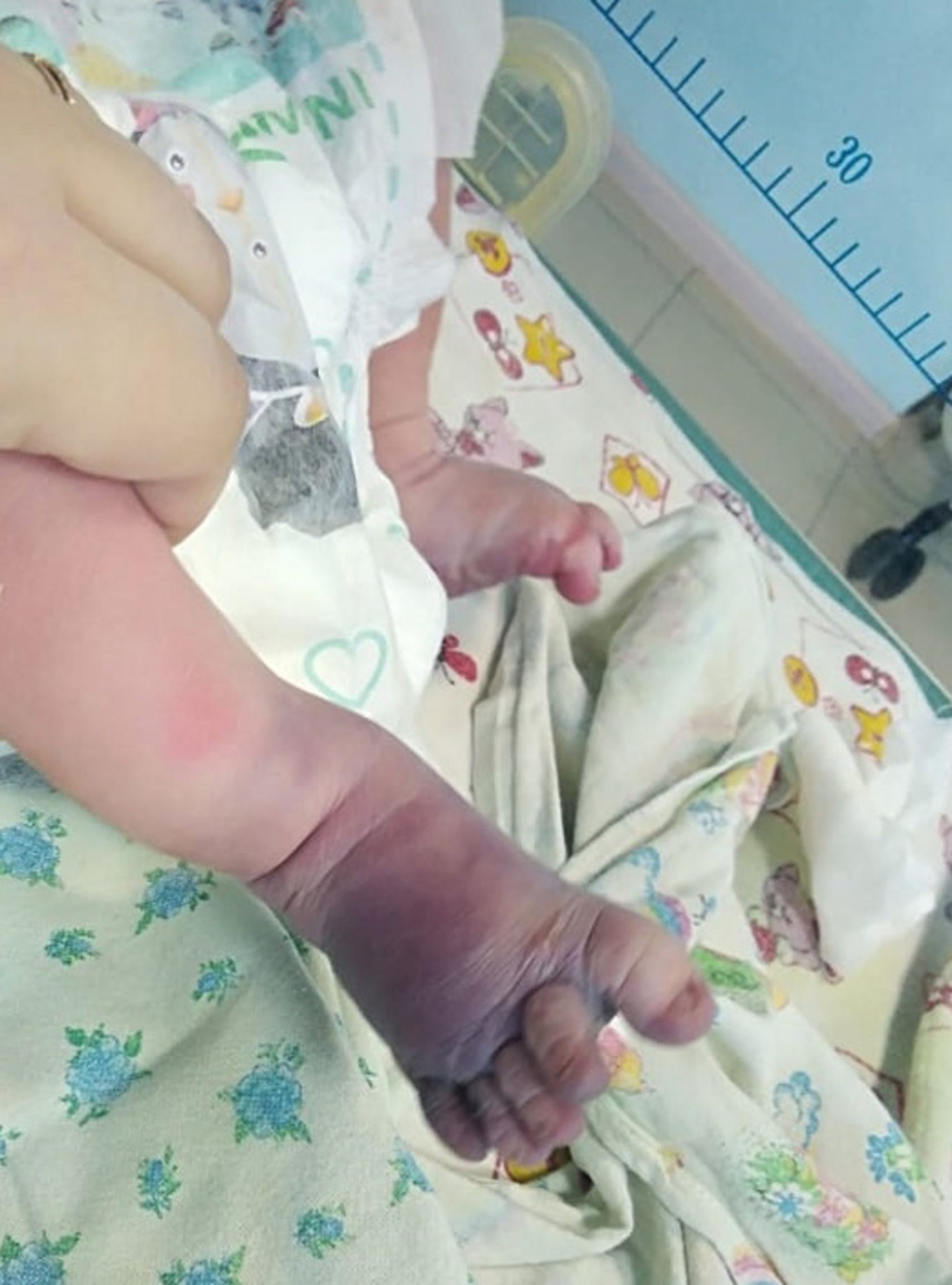 Read more about the article Baby Has Fracture And Nearly Dies In Botched Home Birth