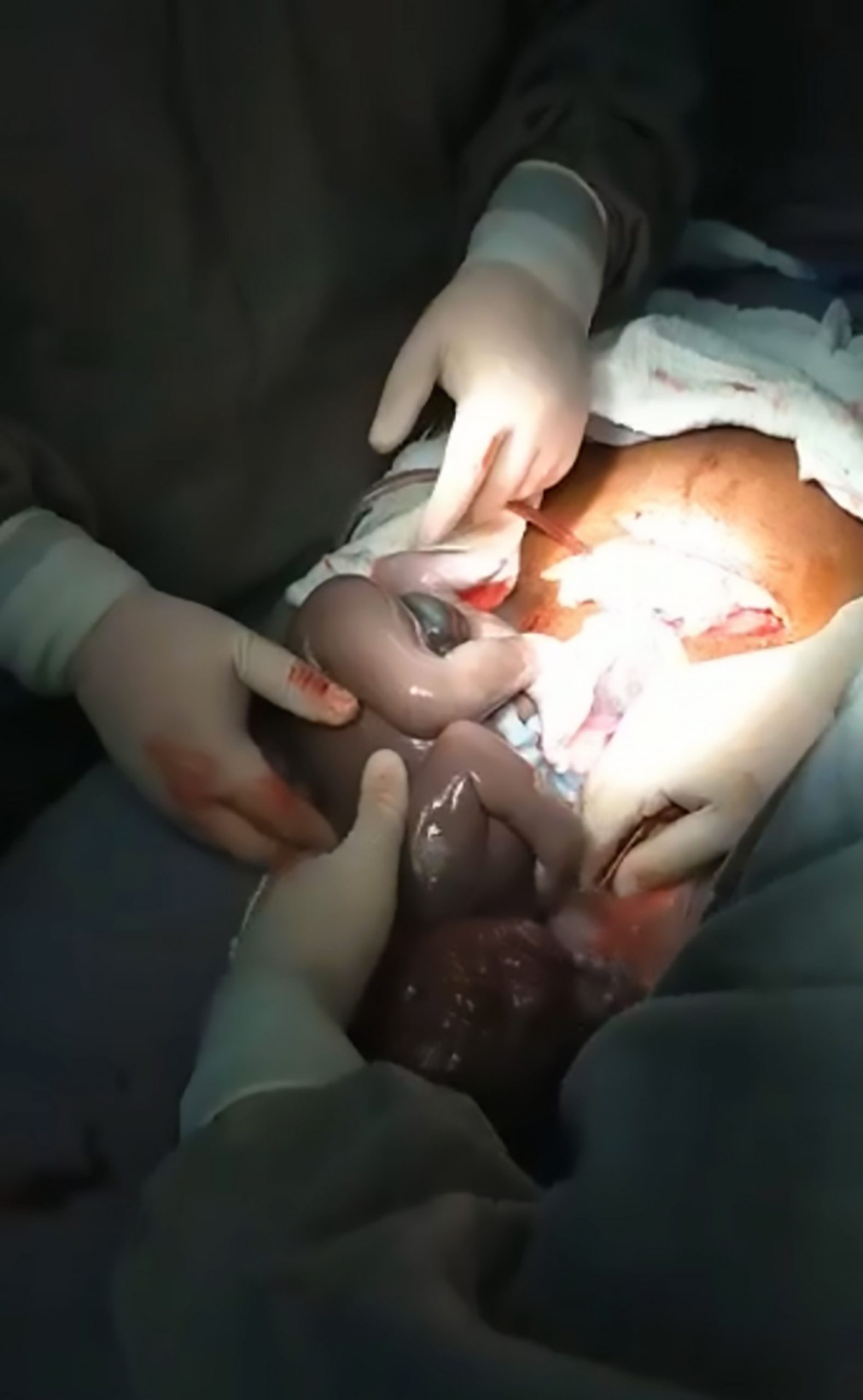 Footage Of Baby Born In Amniotic Sac In Rare Birth - ViralTab
