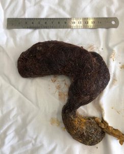 Read more about the article Metre-Long Hairball Pulled Out Of 5yo Girls Gut