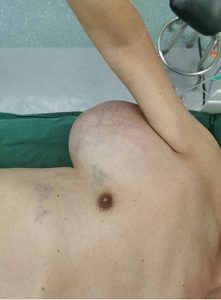 Read more about the article 6 lb Football-Sized Tumour Growing In Mans Armpit