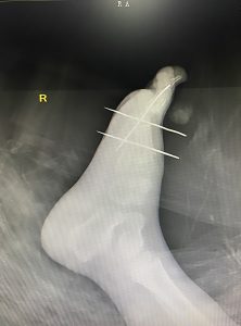 Read more about the article Drs Take 4 Hrs To Find Sewing Needle Stuck In Boys Foot