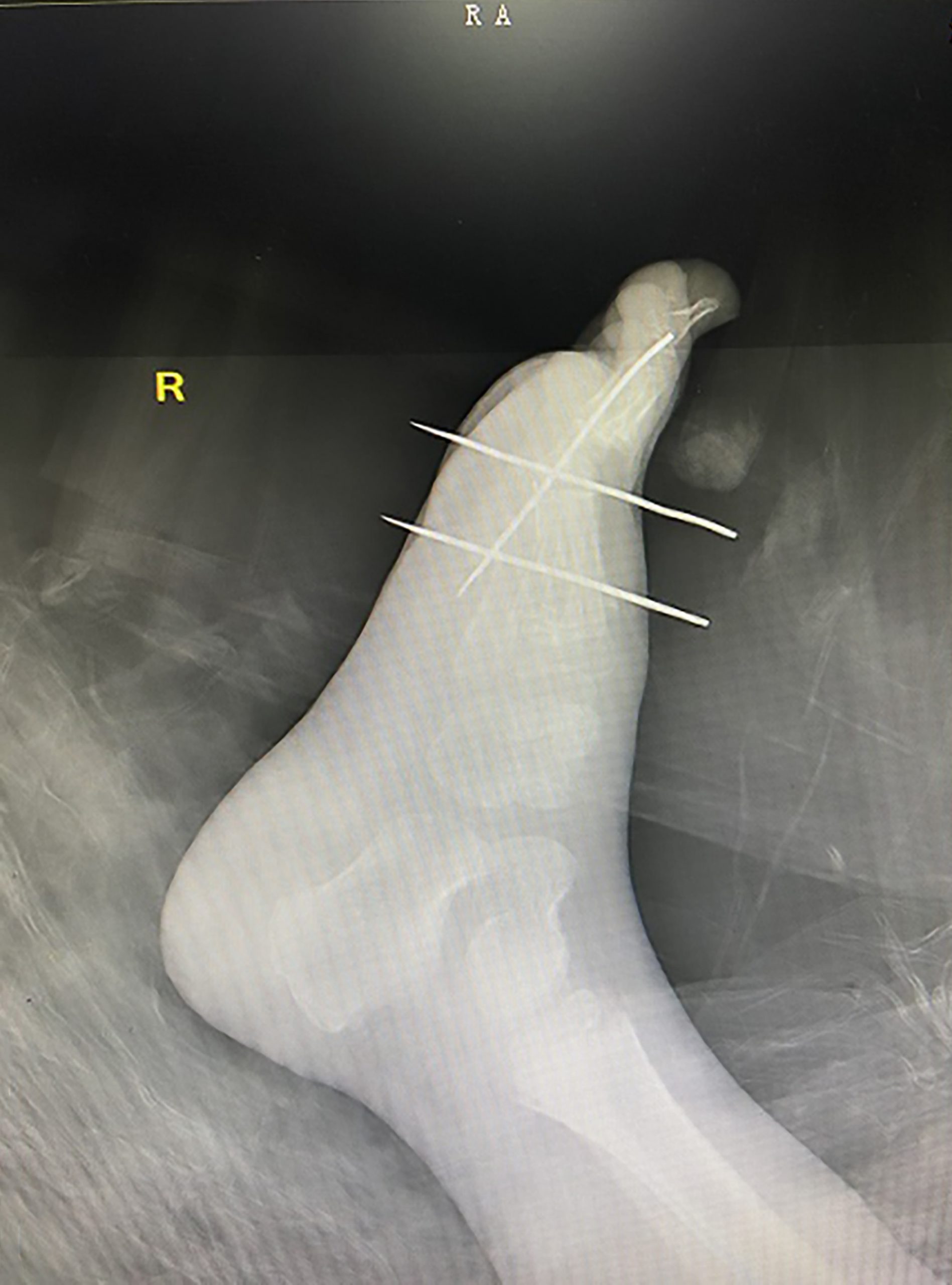 Read more about the article Drs Take 4 Hrs To Find Sewing Needle Stuck In Boys Foot