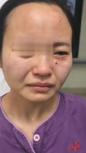Read more about the article COVID-19 Man Bites Chinese Nurse On Face
