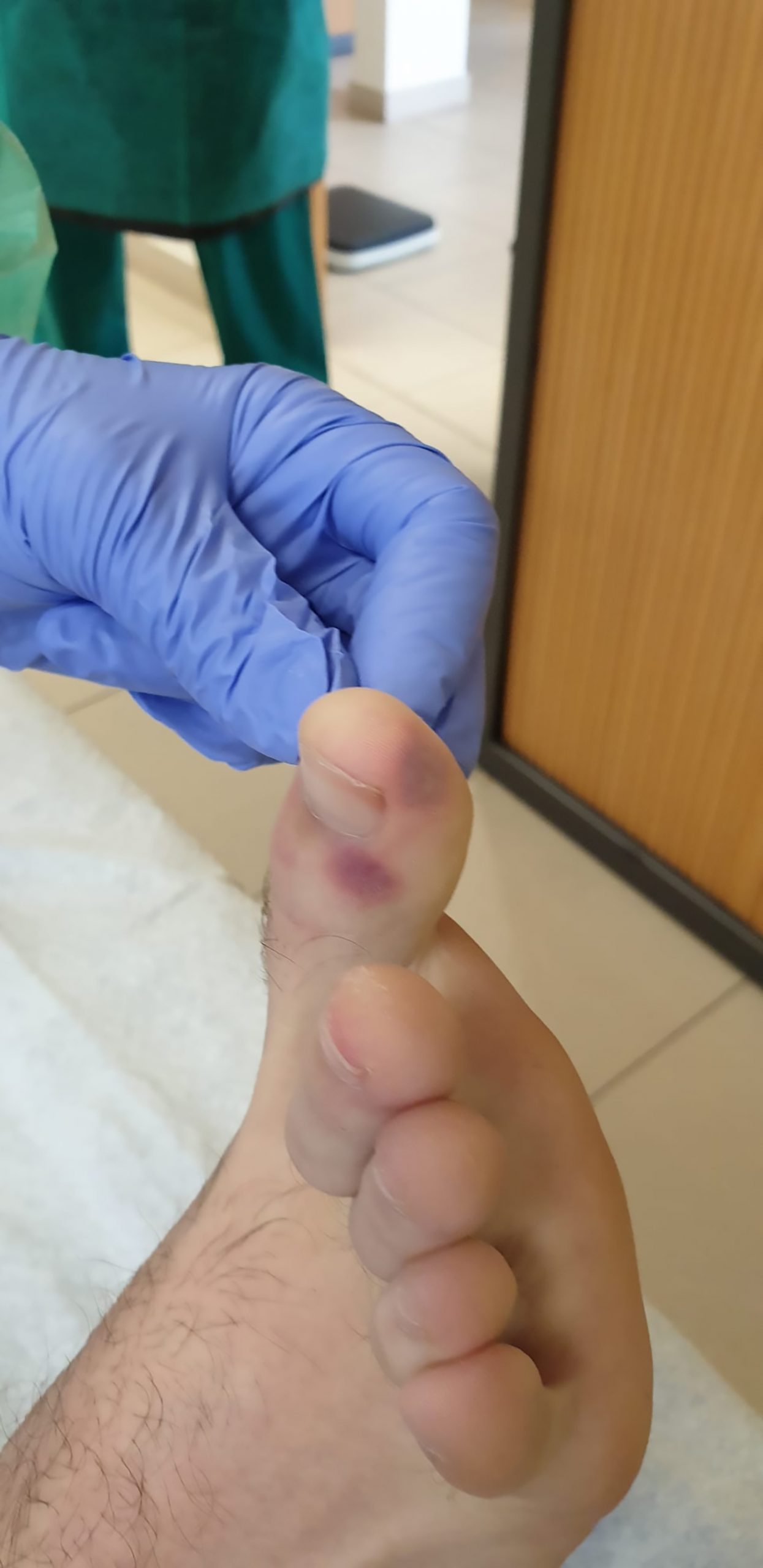 Read more about the article Experts: Purple Feet Marks Could Be Early COVID Sign