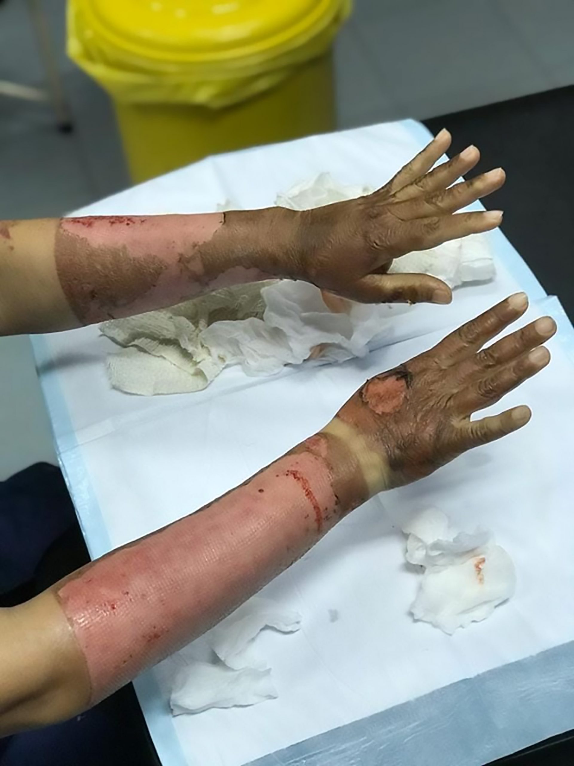 Read more about the article Sanitiser Burning Hands Viral Pic Debunked As Fake News