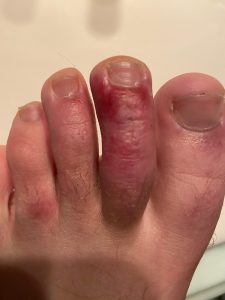 Read more about the article 24yo Spanish Patient Suffers From COVID Toes