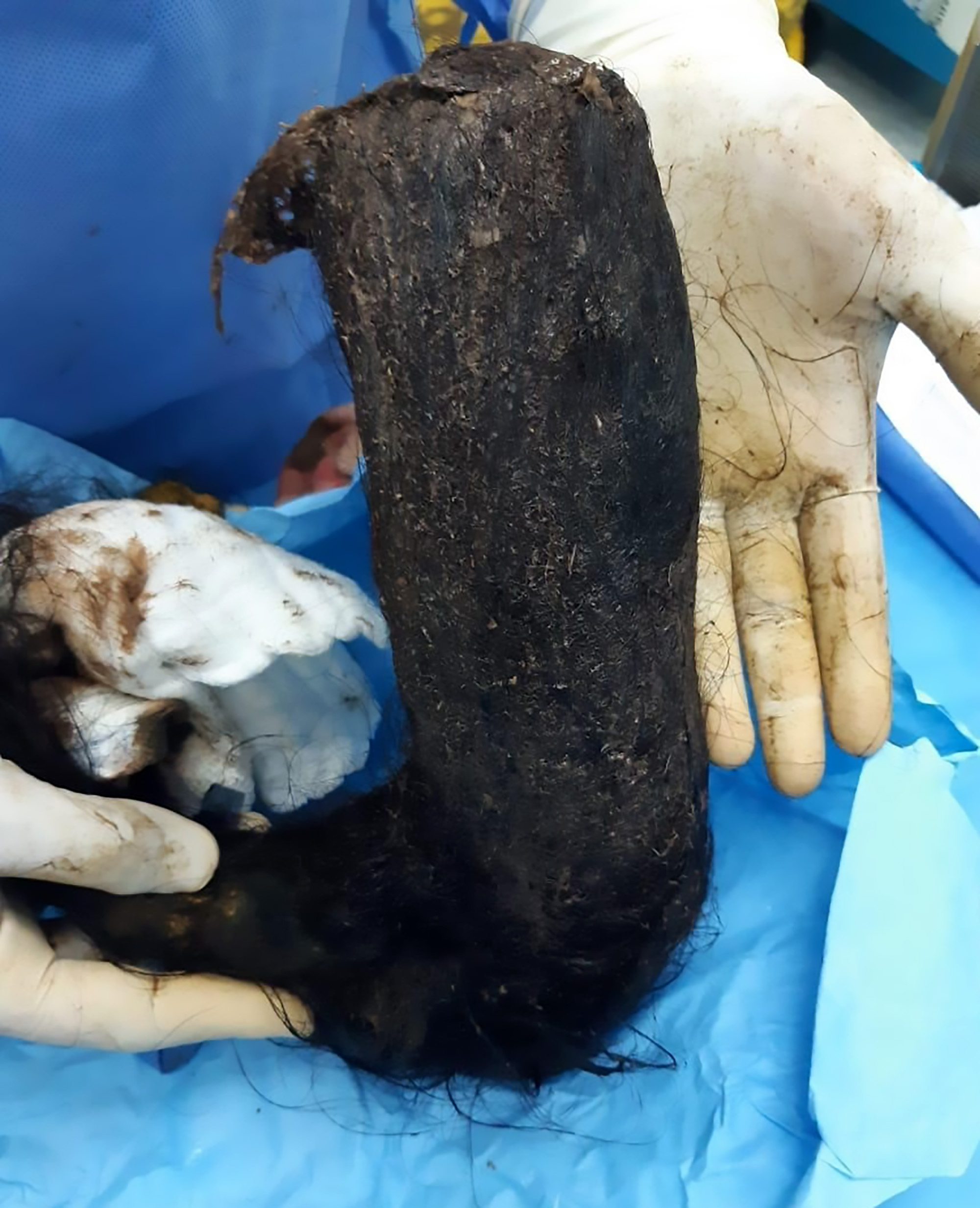 Read more about the article Docs Remove Huge 4-lb Hairball From Womans Stomach