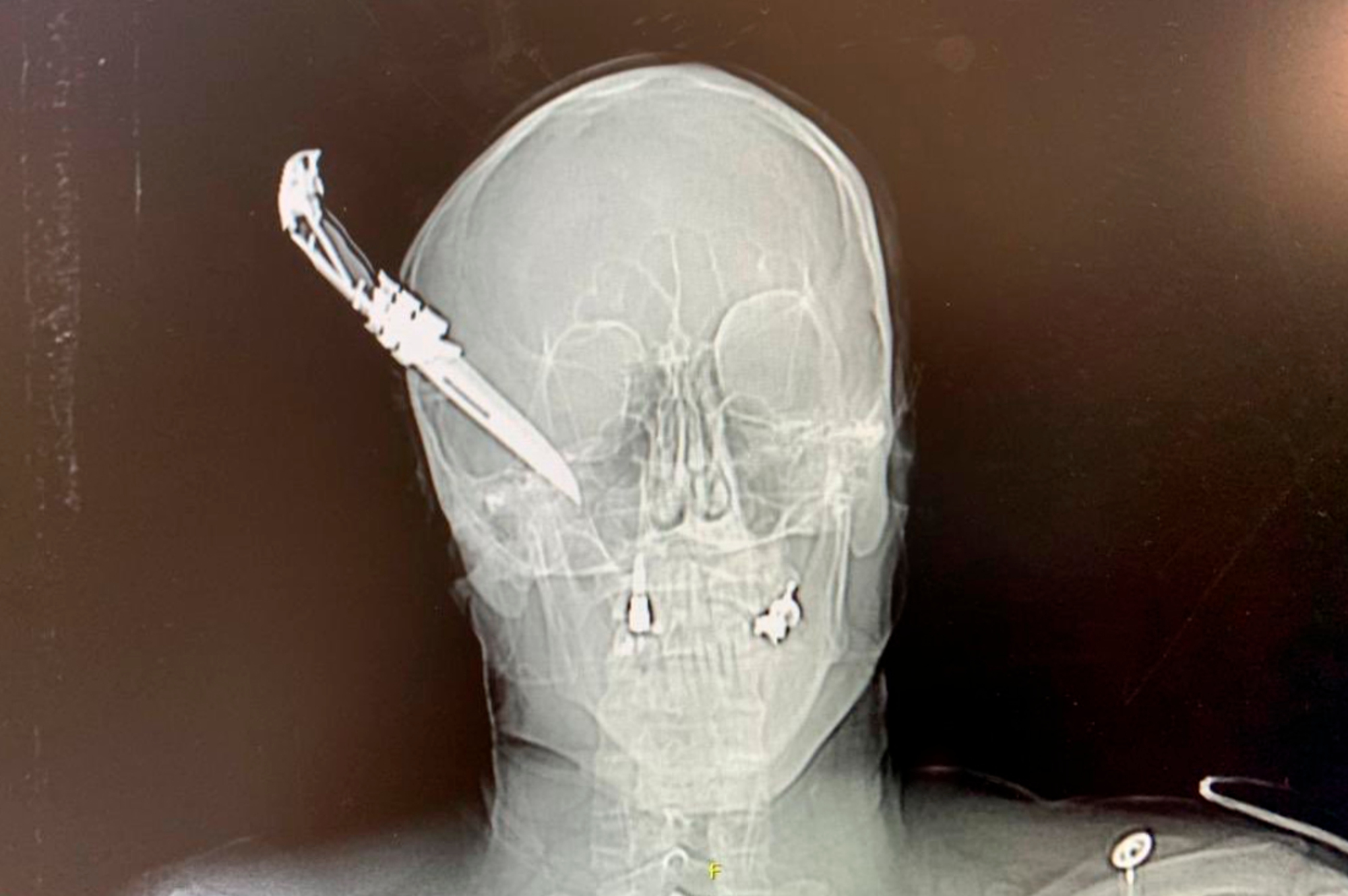 Read more about the article X-Ray Shows Knife Stuck In 60yo Have-A-Go Heros Head