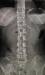 Read more about the article X-Ray:Woman Swallows Toothbrush Trying To Dislodge Meat