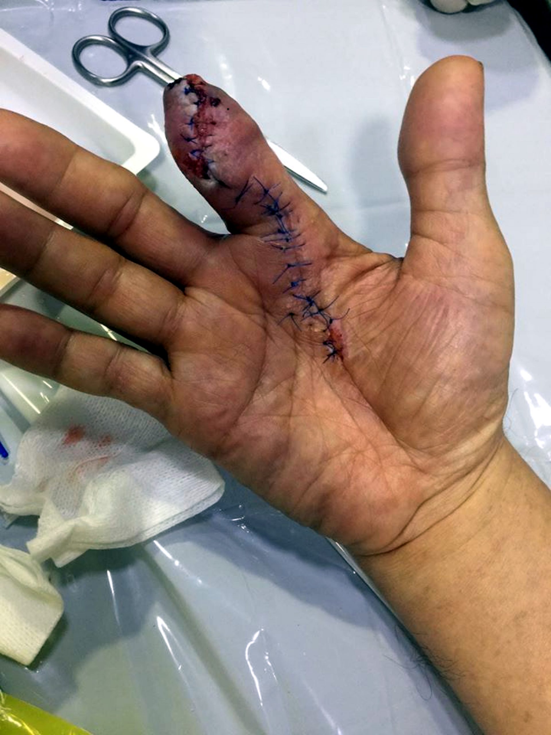 Read more about the article Shock Pic As Man Loses Finger From Peeling Prawns