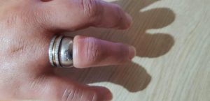 Read more about the article Firefighters Cut Ring From Womans Swollen Finger