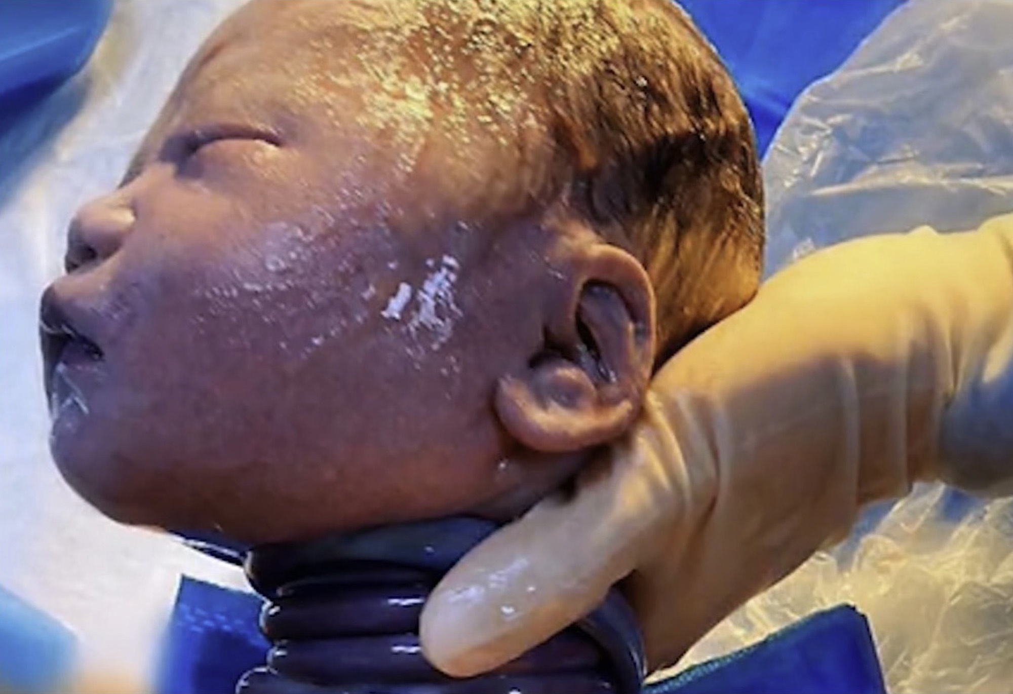 Read more about the article Baby Has Umbilical Cord Wrapped Six Times Round Neck
