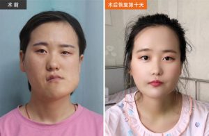 Read more about the article Crooked Face Girl Wants Boyfriend After Amazing Surgery