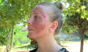 Read more about the article Woman Has 2nd Degree Burns On Face After Skin Treatment