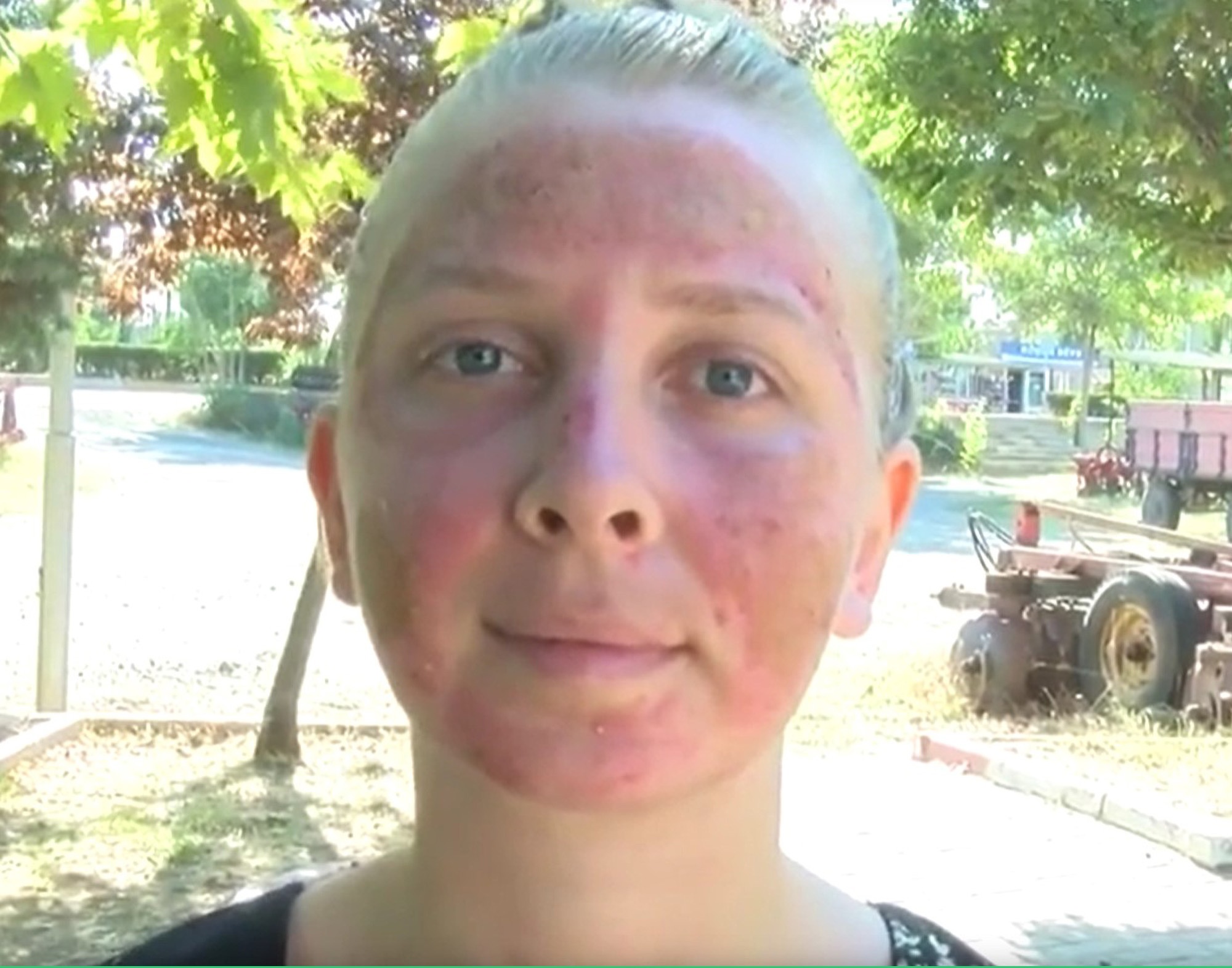 chemical burn on face from face wash