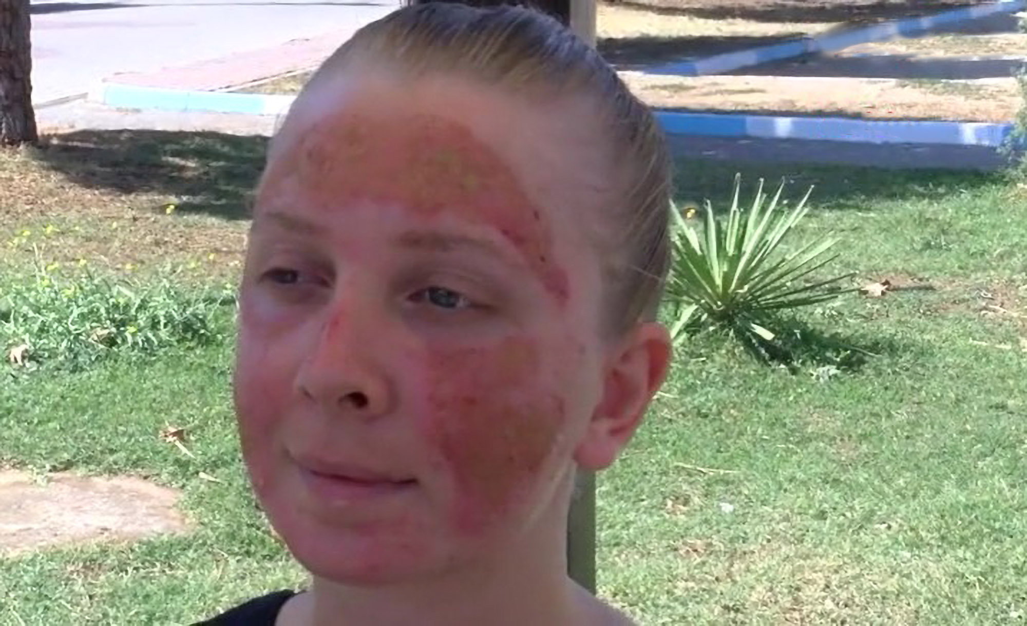 woman-has-2nd-degree-burns-on-face-after-skin-treatment-viraltab