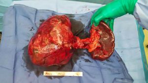 Read more about the article Huge Tumour Weighing Size of Cat Removed from Patients Pancreas