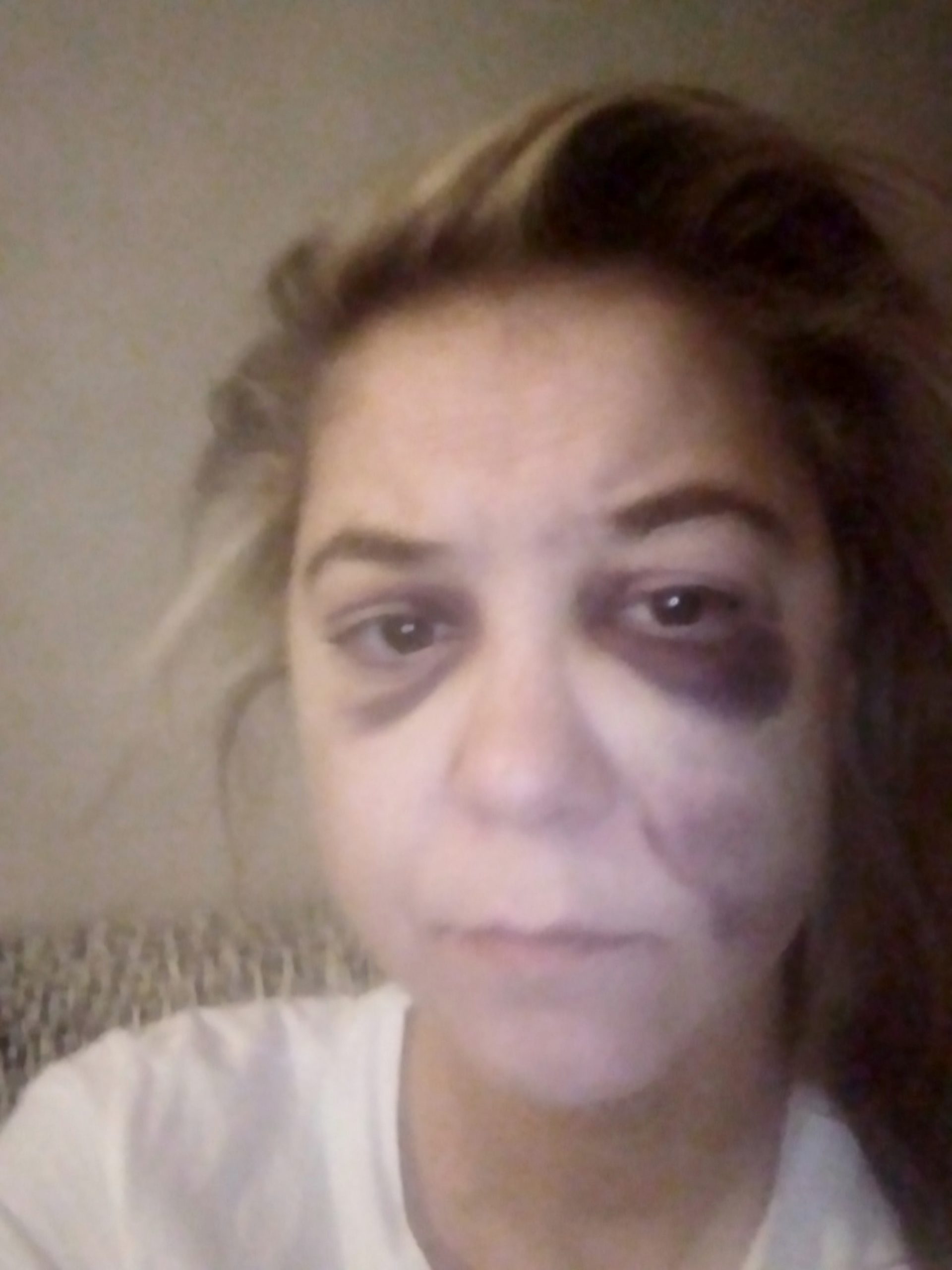 Read more about the article Never Again As Brave Woman Posts Pics Of Injuries When Beaten By Abusive BF On Dads Funeral