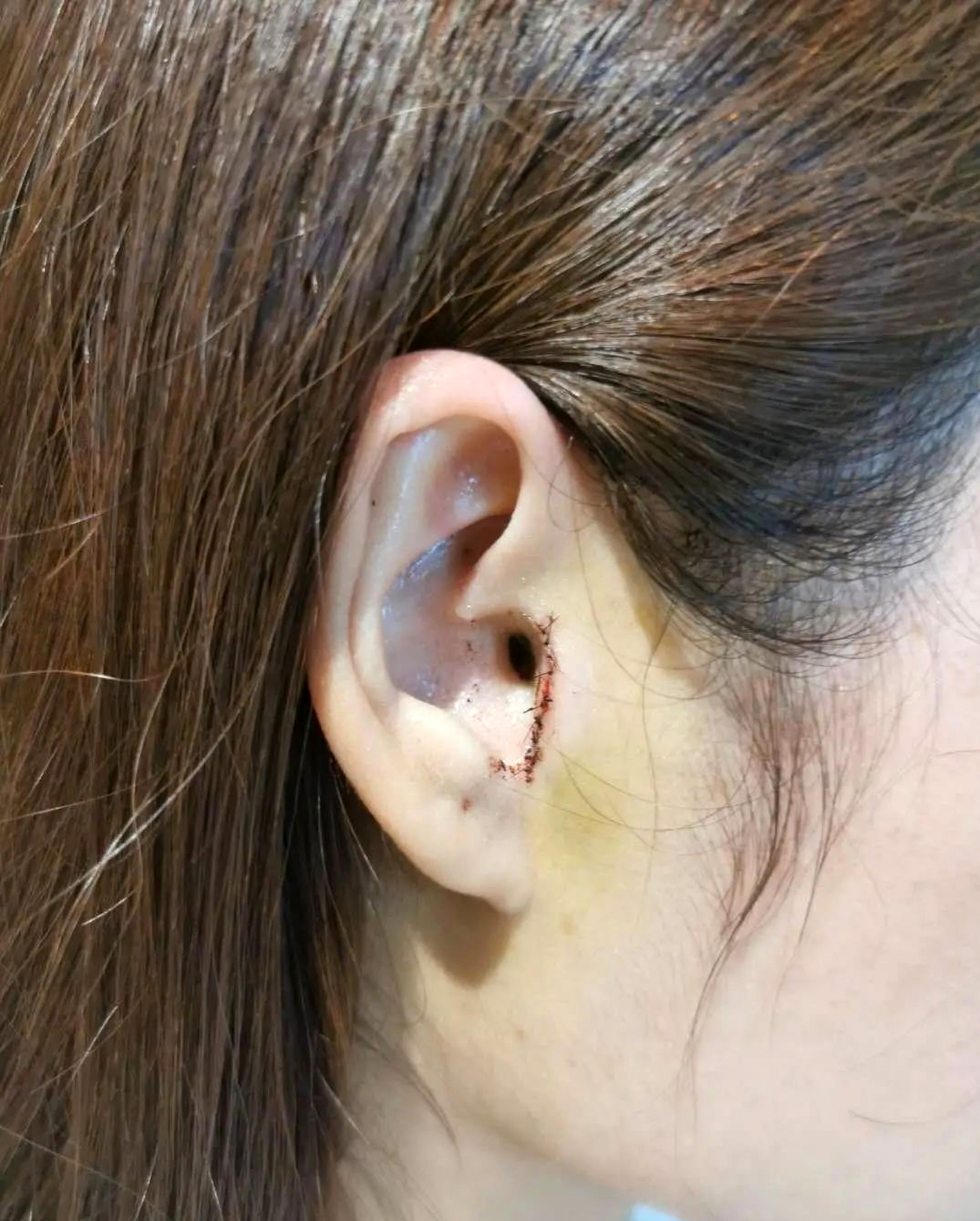 Read more about the article Woman Finds Part Of Ear Missing After Nose Job And Says Wireless Headphones No Longer Fit