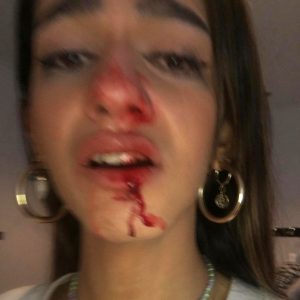 Read more about the article Spanish Trans Teen Beaten In Front Of Home By 2 Haters