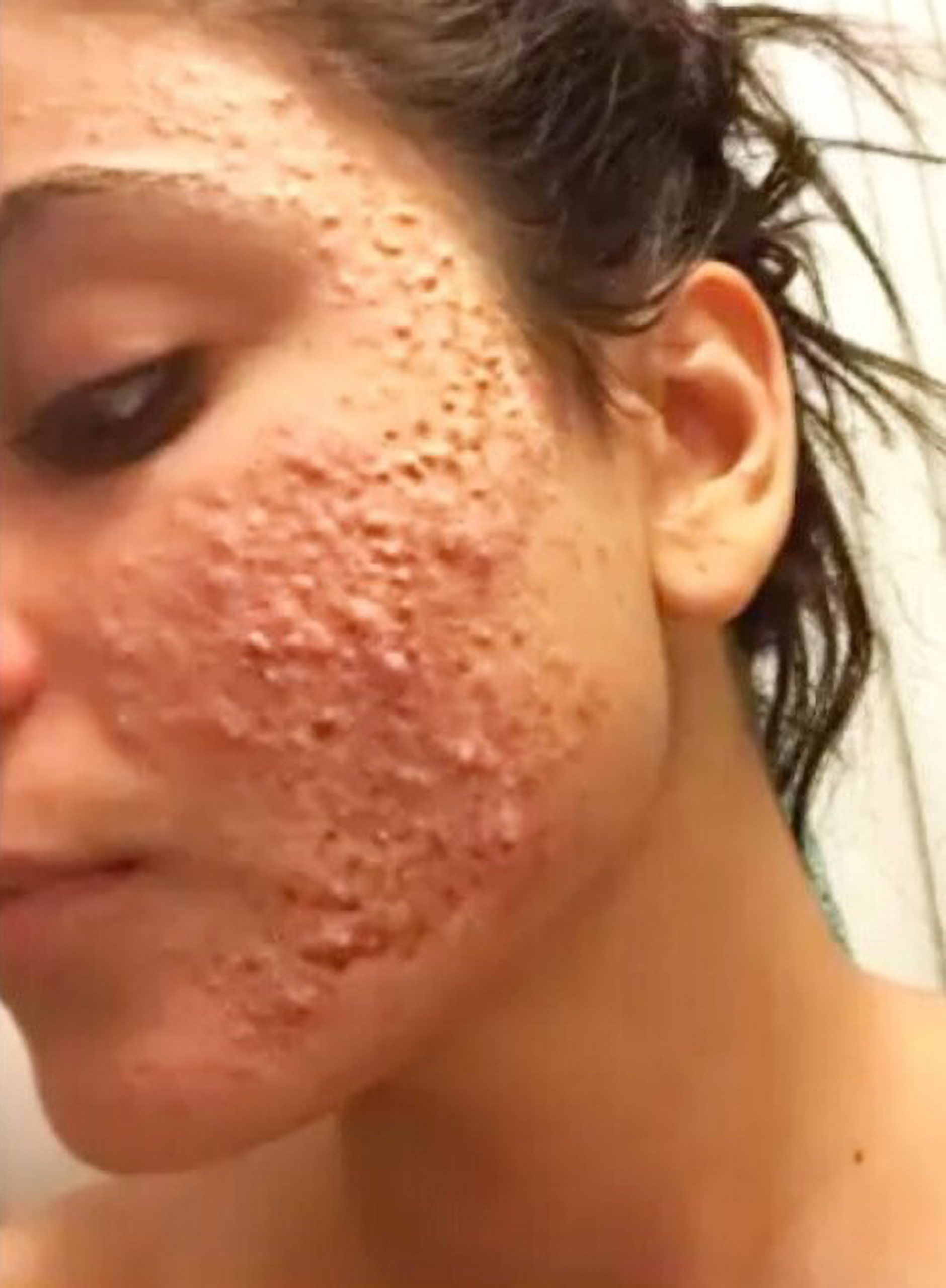 Read more about the article German Influencer Reveals Shocking Acne Before Blossoming Into Gorgeous Model