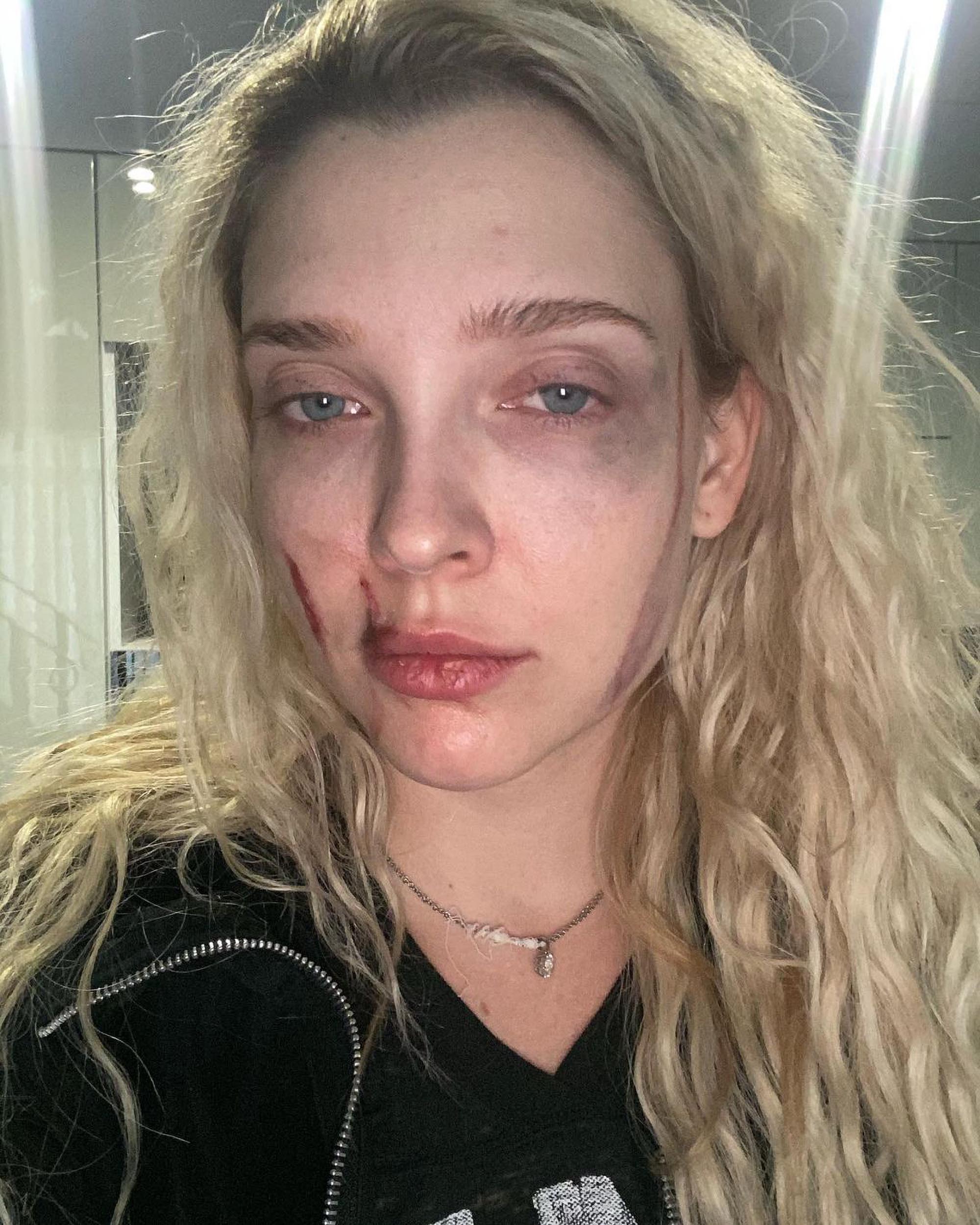 Read more about the article Actress Posts Snaps Of Beaten Face After Jealous Attack In Moscow Club#HOLD?