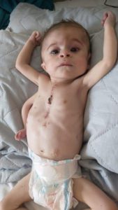 Read more about the article Baby Born With 3 Arms And Half A Heart