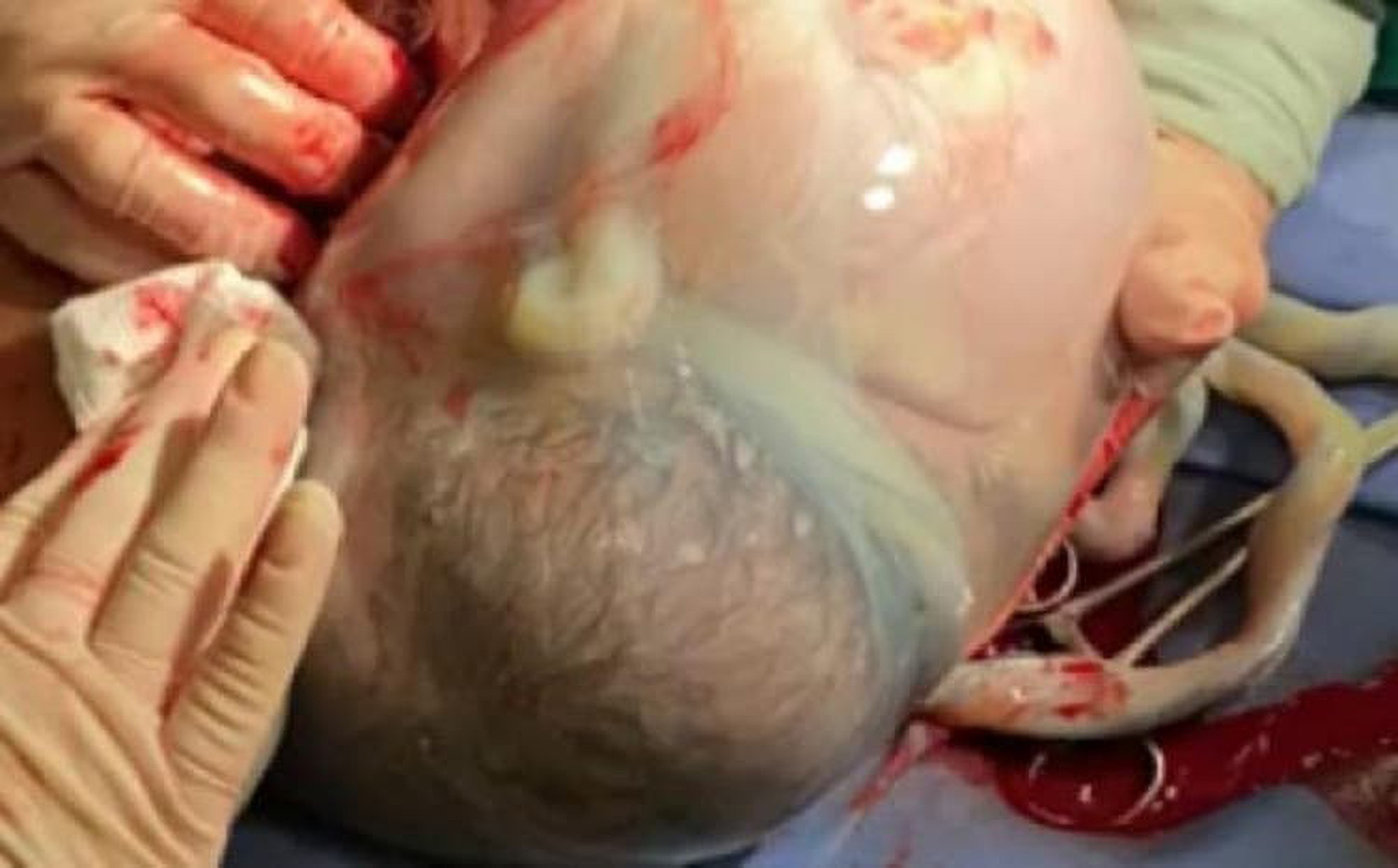 Read more about the article Baby Born In Amniotic Sac In Rare En Caul Birth In Brazil