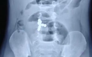 Read more about the article Surgeons Removed 117 Magnetic Balls From Stomach Of One Year Old
