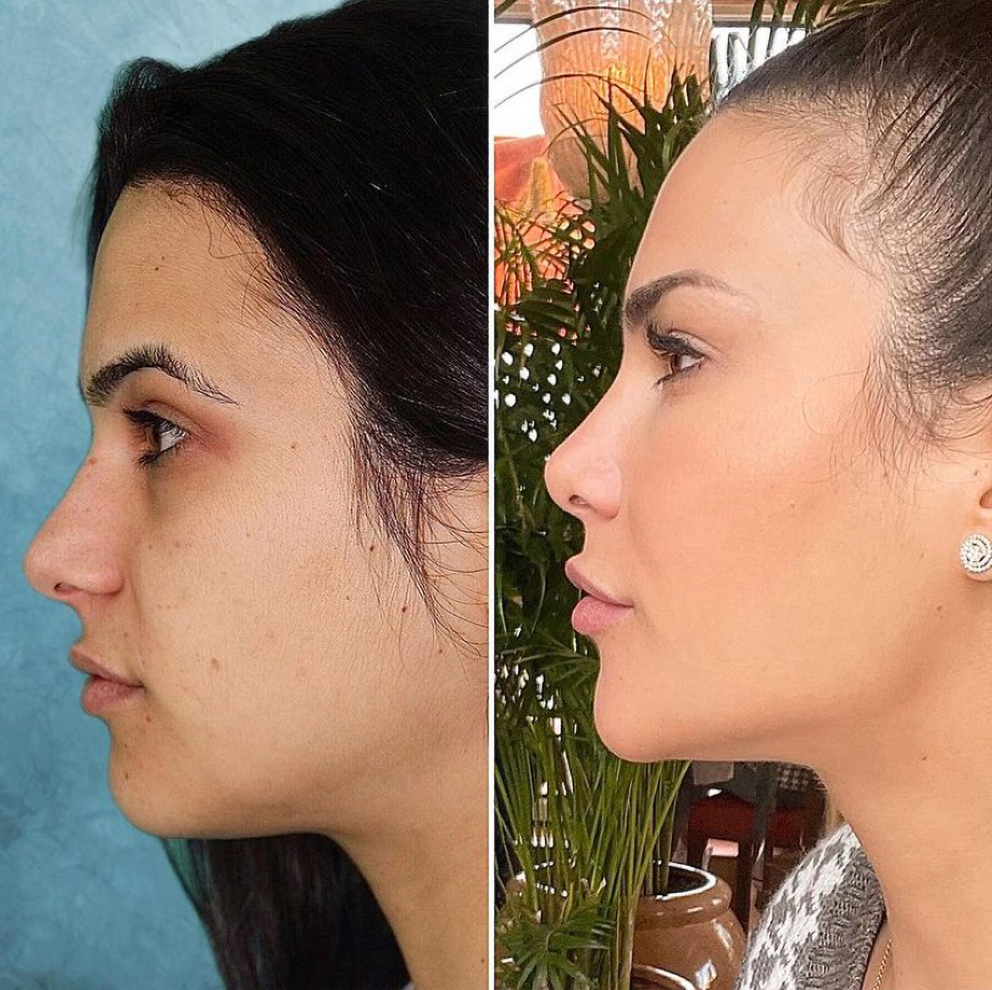 Read more about the article Miss Spain Shares Before-After Snap After Numerous Cosmetic Ops