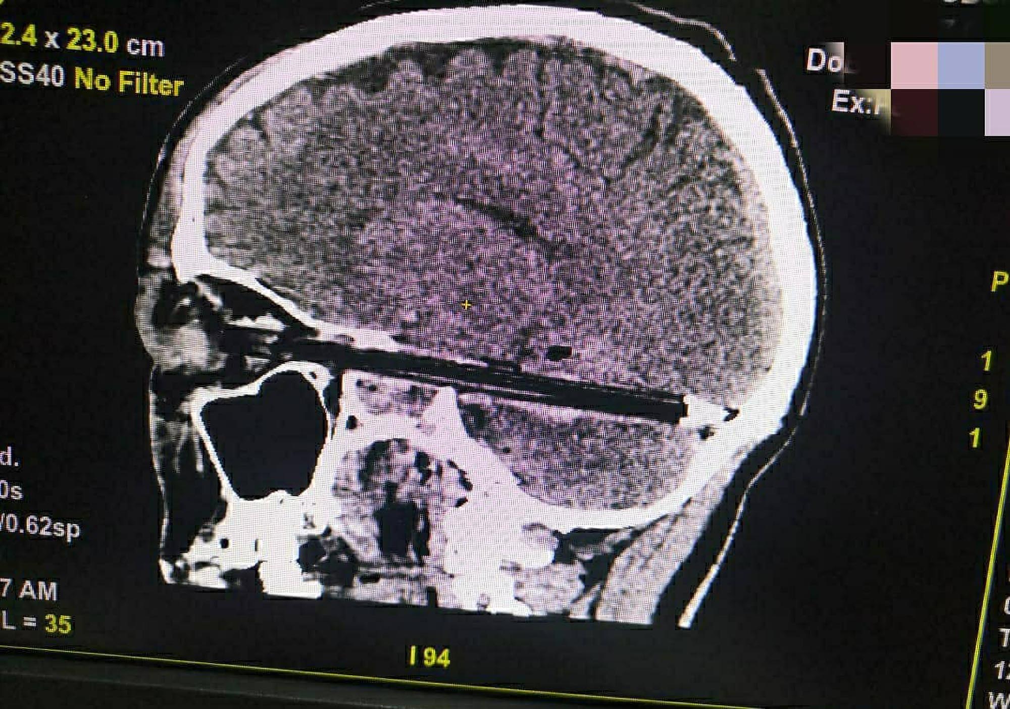 Read more about the article Man Dies After Sticking Pen Through Eye And Into His Brain During Breakdown