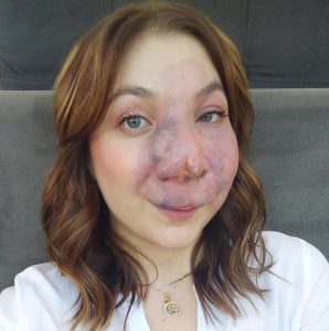 Read more about the article Inspirational Woman Who Was Bullied Because Of Haemangioma Now Says She Loves Her Face