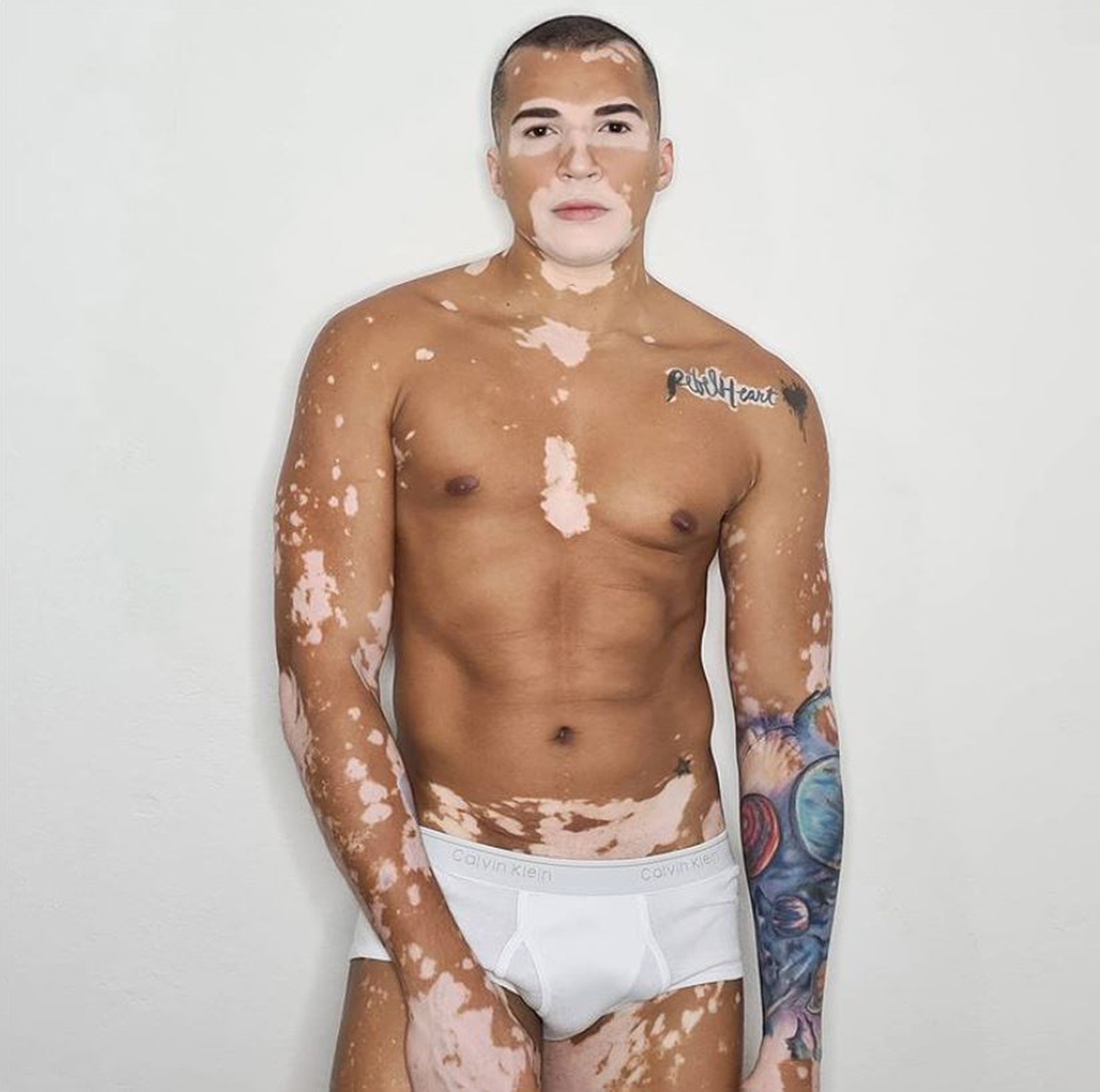 Read more about the article Model With Vitiligo Shows He Is Now Proud Of His Colourful Body With Daily Insta Posts