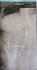 Read more about the article Mother Of Seven Who Had Tummy Tuck Left In Agony After Surgeon Forgot Scissors Inside Her