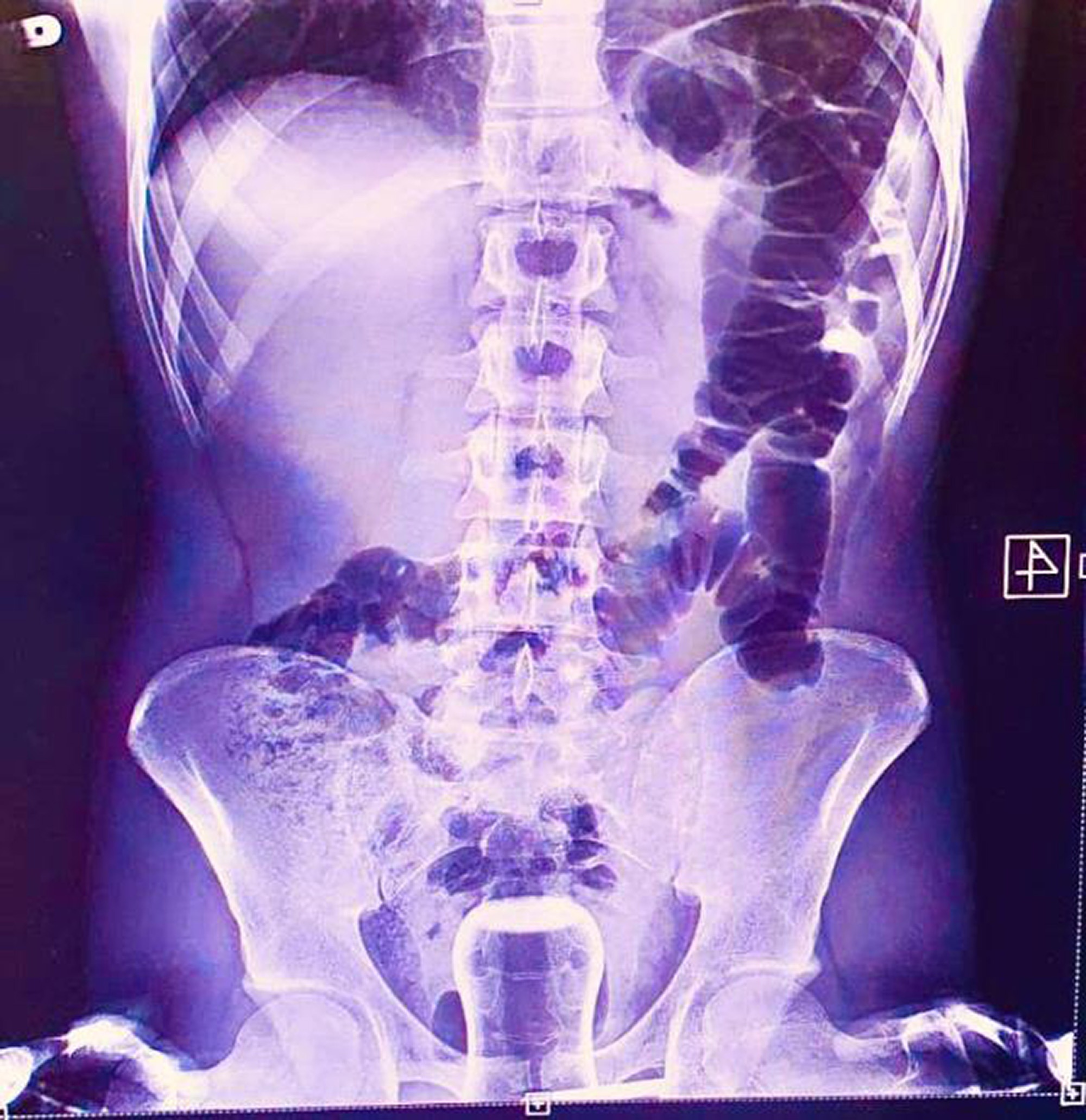 Read more about the article Turkish Man Claims Glass Ended Up In Bottom After It Was Used To Push His Haemorrhoids Back In