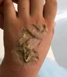 Read more about the article Girl, 4, Left With Third Degree Hand Burns After Smartwatch Explodes
