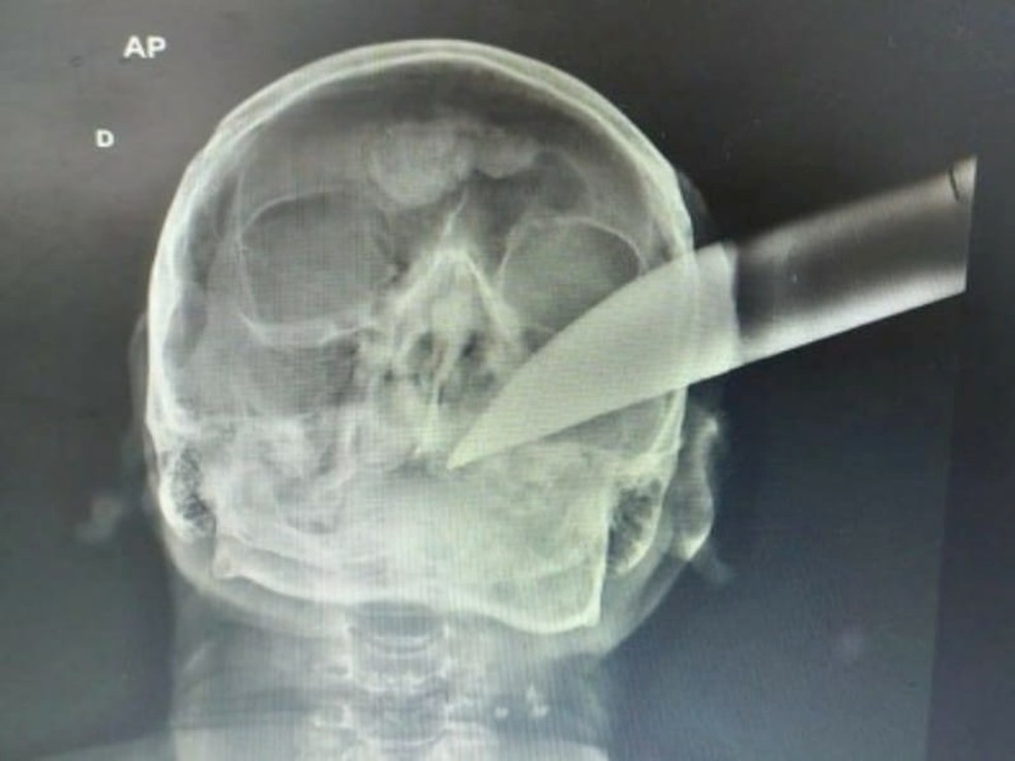 Read more about the article Man Survives Going For 9 Hours With Machete Stuck In Head Following Fight At Home