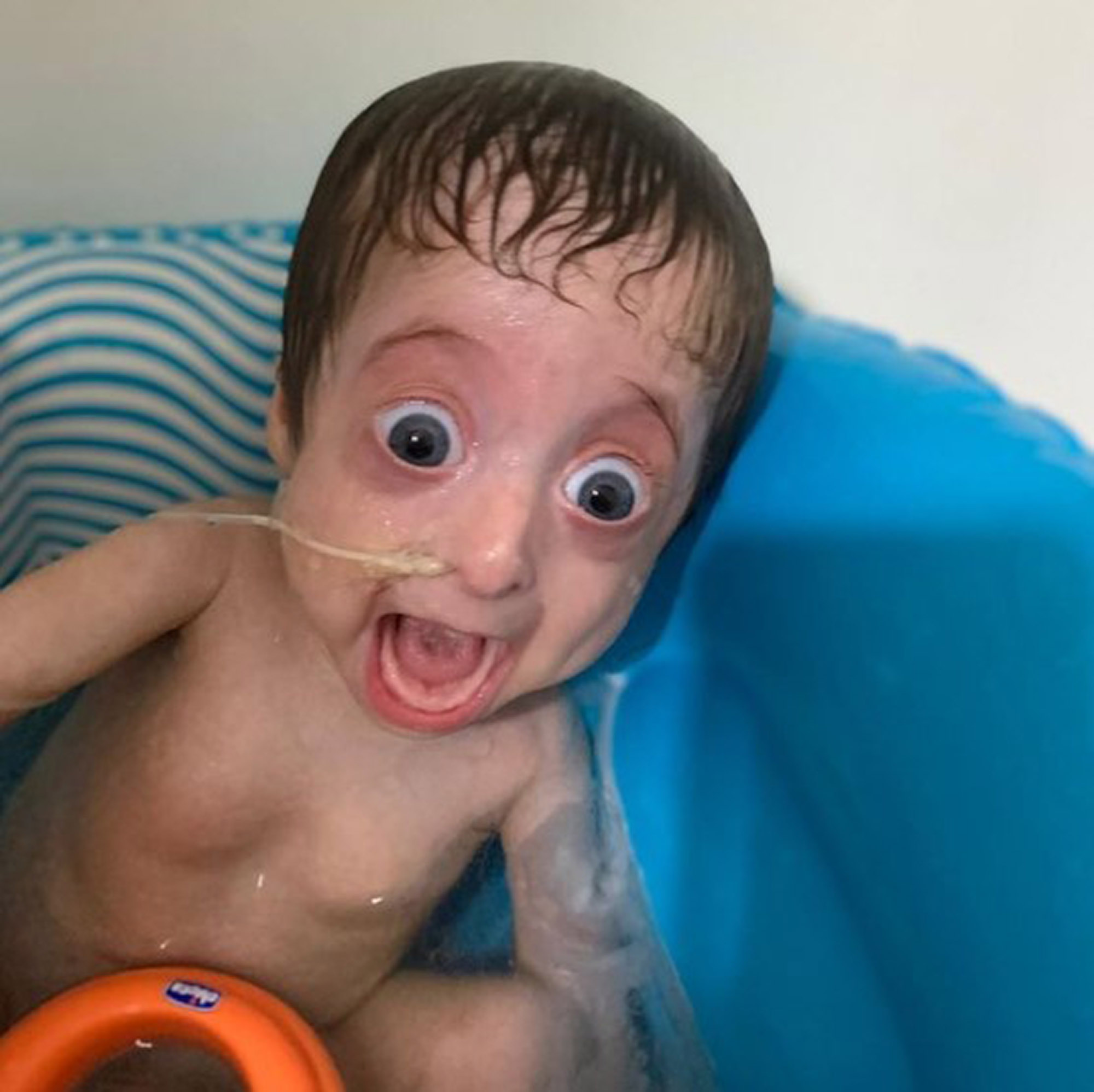 Read more about the article Benjamin Button, Little Boy Born With Old Man Syndrome Wins Hearts Worldwide