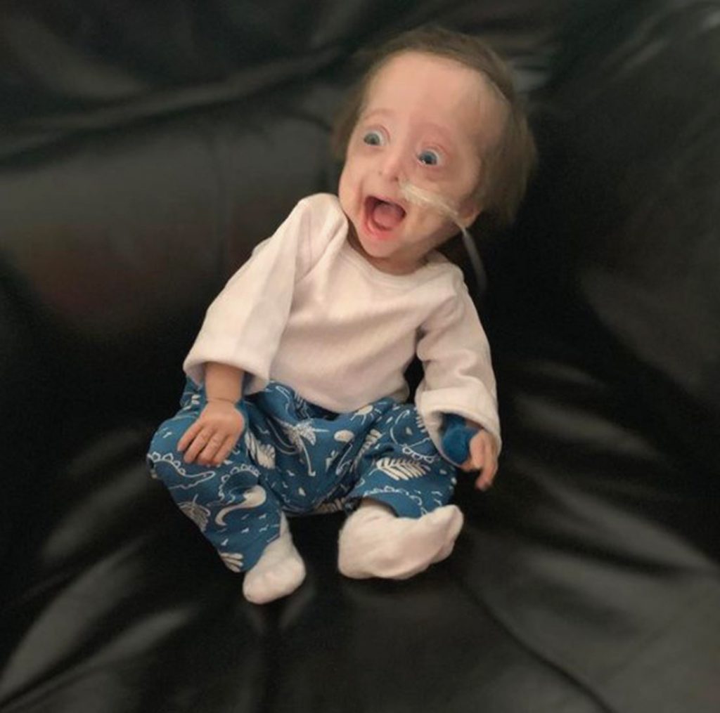 Benjamin Button, Little Boy Born With Old Man Syndrome Wins Hearts ...