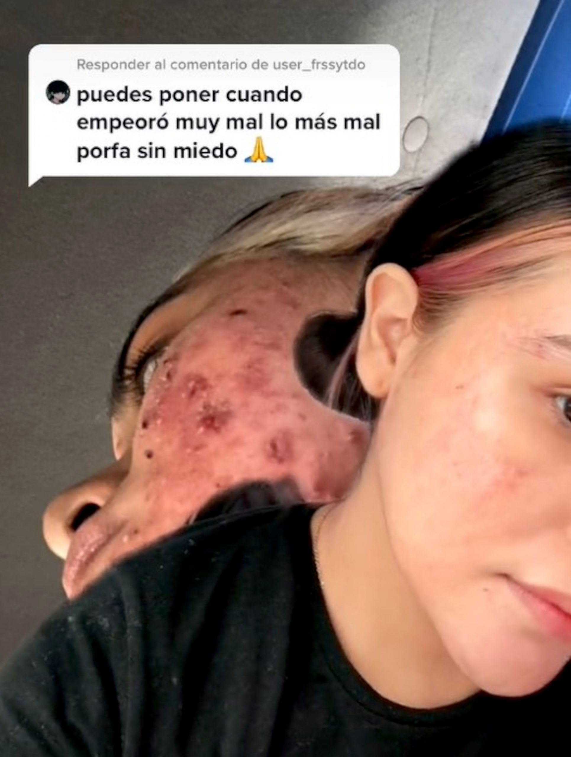 Read more about the article Teen Shares Incredible Transformation From Having Severe Acne From Stress During Pandemic To Being Acne Free In 6 Months