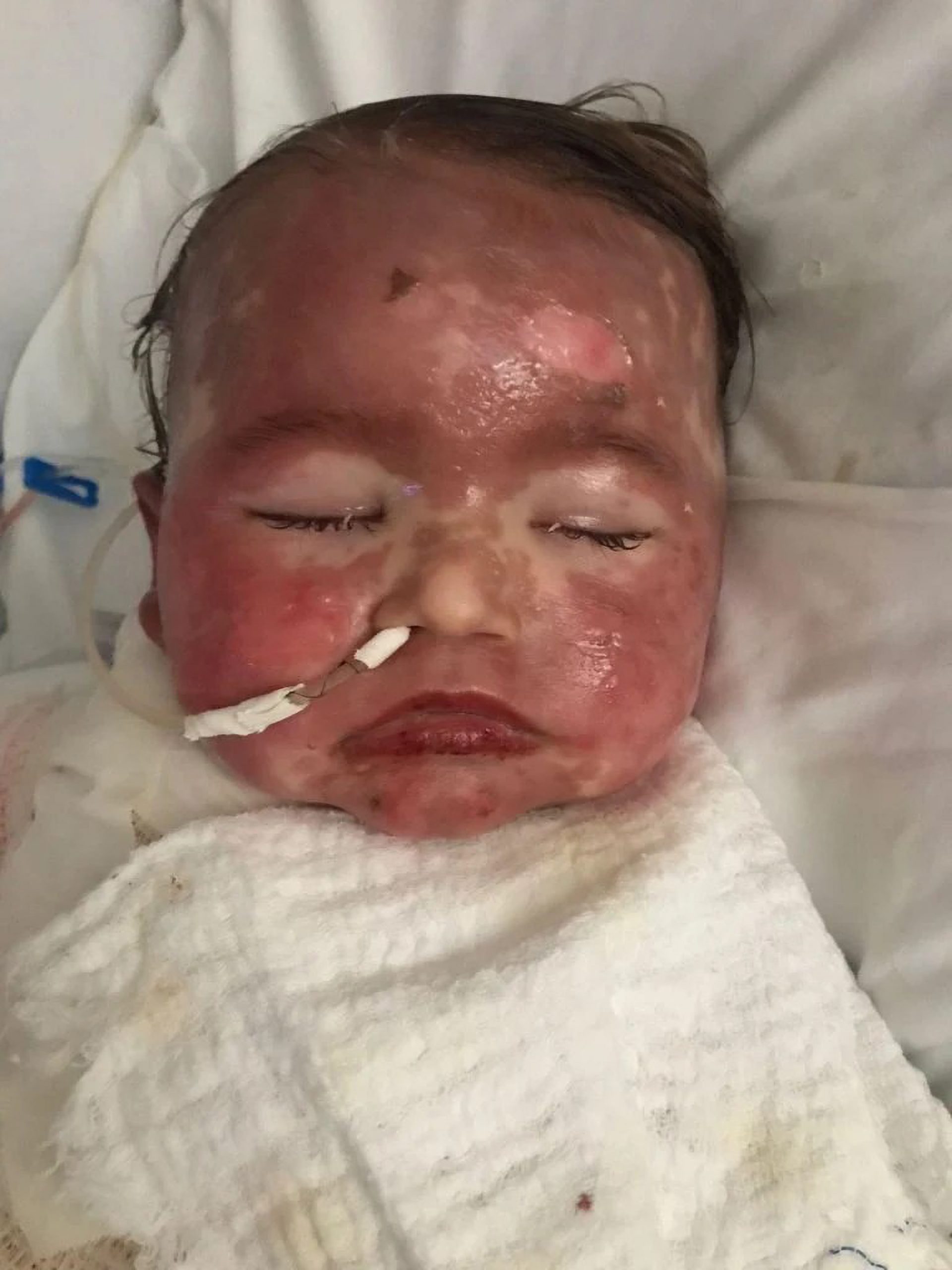 Read more about the article Toddler In ICU After Severe Reaction To Medication Resulting In Burn Like Rashes All Over Her Body