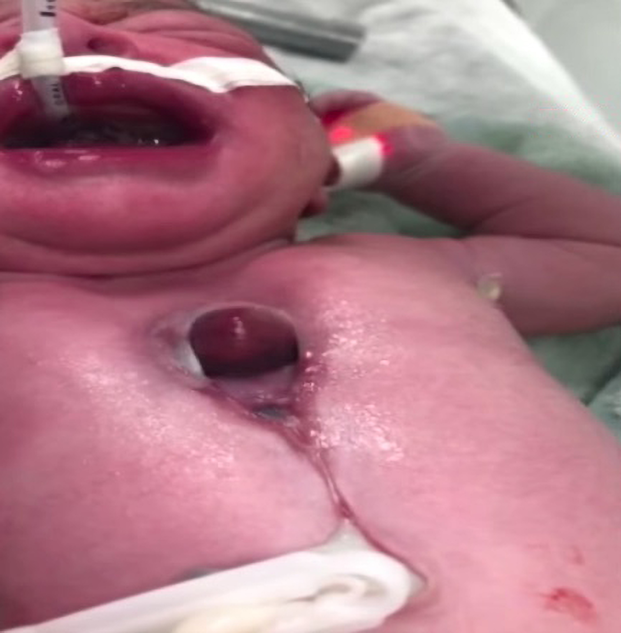 Read more about the article Doctors Save 3 Month Old Baby Who Was Born With Rare Condition That Left Heart Outside His Chest