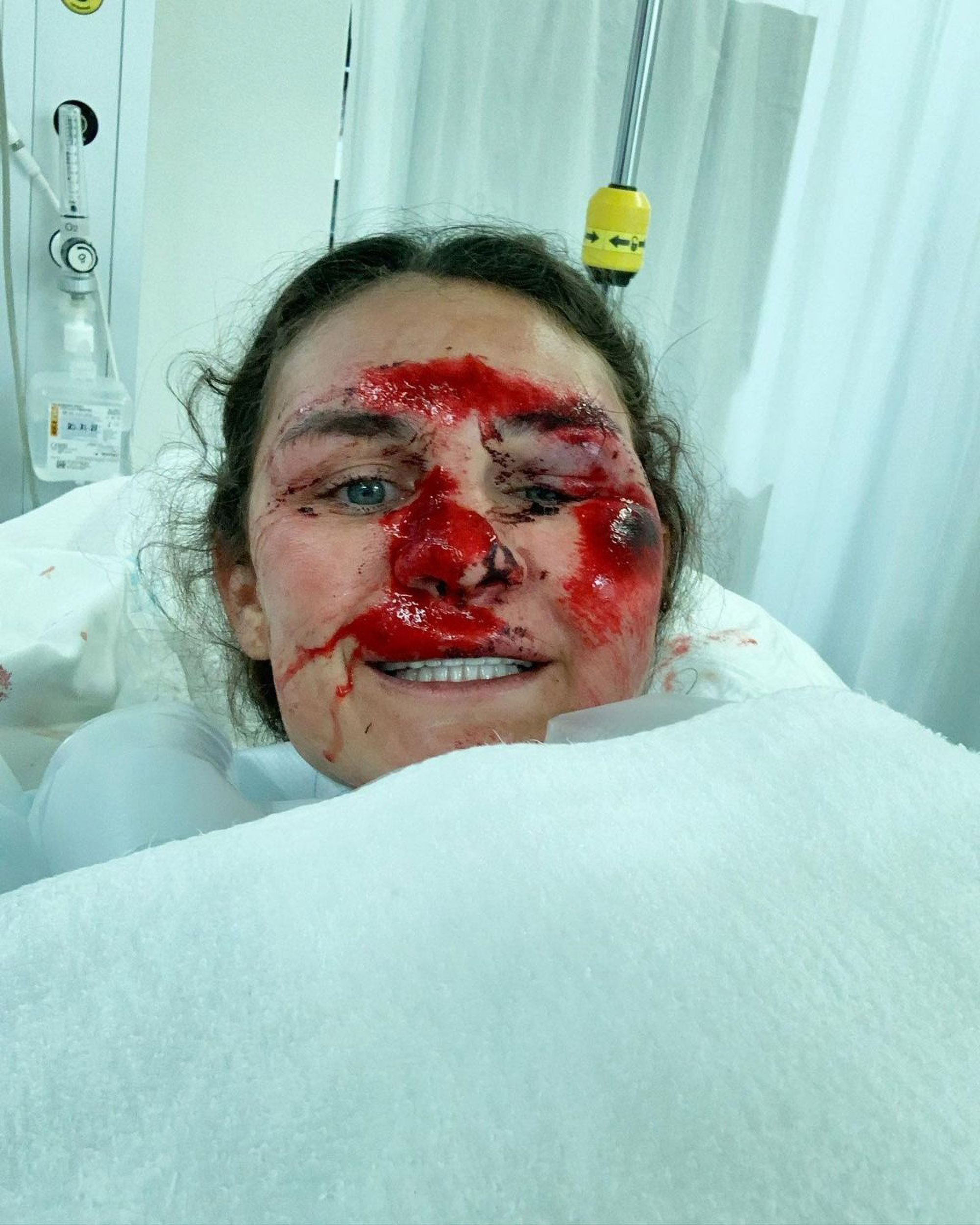 Read more about the article Amazing Recovery For American World Cup Skiing Ace After Horror Accident Left Her Looking Disfigured