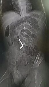 Read more about the article Boy, 3, Has Intestines Punctured Four Times After Swallowing 11 Magnetic Beads