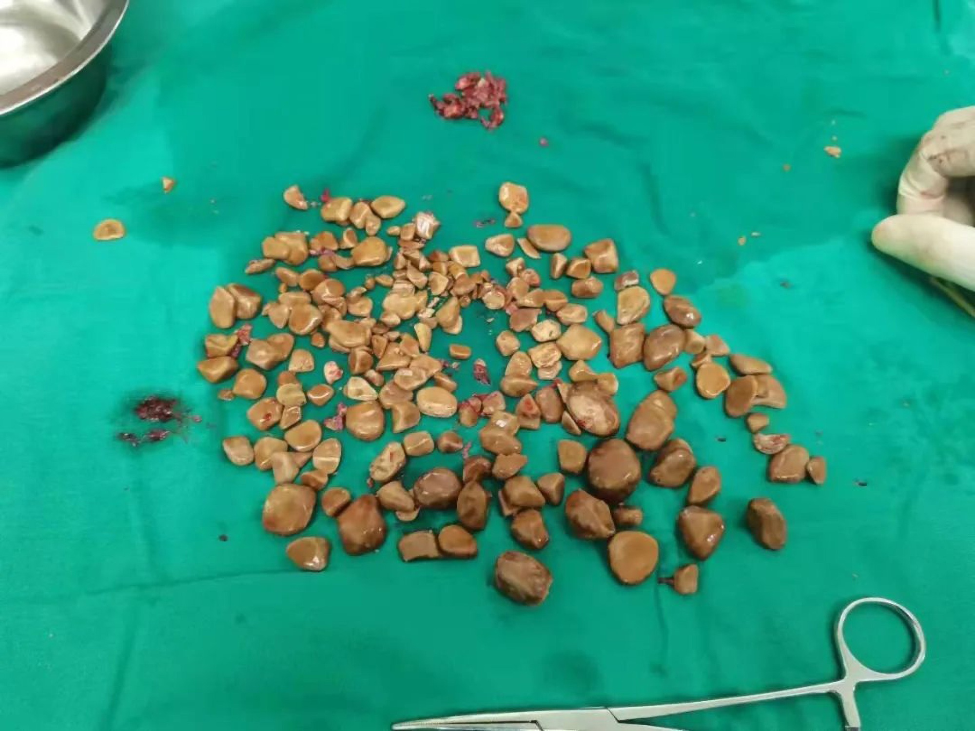 Read more about the article Man Has Nearly 200 Bladder Stones Removed After Doctors Find Blood In His Pee