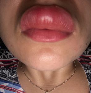 Read more about the article Nightmare As Young Woman Has Giant Lip After Creepy Crawly Centipede Bites Her In Sleep